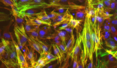 Photo: UW–Madison researchers studied smooth muscle cells like these, derived from induced pluripotent stem cells, to show that long-mysterious variations in an area of our genome harden blood vessels, puting some people at higher risk for cardiovascular disease. Image courtesy Lo Sardo Lab/UW–Madison