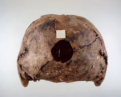 Pierced skull of one of the French soldiers of El Carrascal.