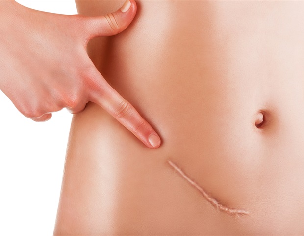 Study reveals the genetic underpinnings of a rare and aggressive ovarian cancer