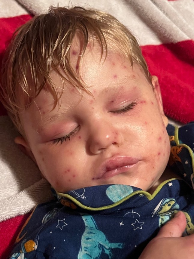 A 2-year-old boy was left fighting for his life after he was stung more than 150 times by yellow jackets, shutting down key organs. Little Beckham Reed ? who was born with just one kidney ? was swarmed by the wasps when he bumped into a nest while riding in a toy car with his cousins in Georgia, according to a family fundraiser. His parents rushed him to an emergency room, where he was given morphine and Benadryl.