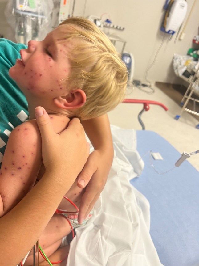 A 2-year-old boy was left fighting for his life after he was stung more than 150 times by yellow jackets, shutting down key organs. Little Beckham Reed ? who was born with just one kidney ? was swarmed by the wasps when he bumped into a nest while riding in a toy car with his cousins in Georgia, according to a family fundraiser. His parents rushed him to an emergency room, where he was given morphine and Benadryl.