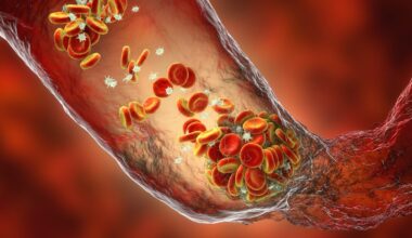 Genetic Risk Score Developed for Venous Thromboembolism