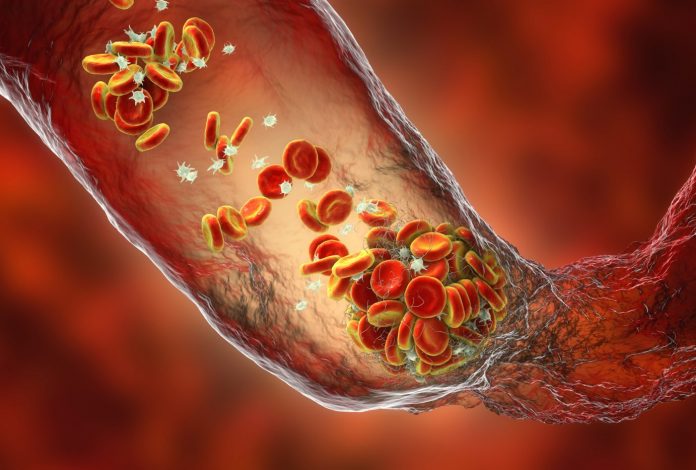 Blood clot made of red blood cells, platelets and fibrin protein strands. Thrombus. VTE