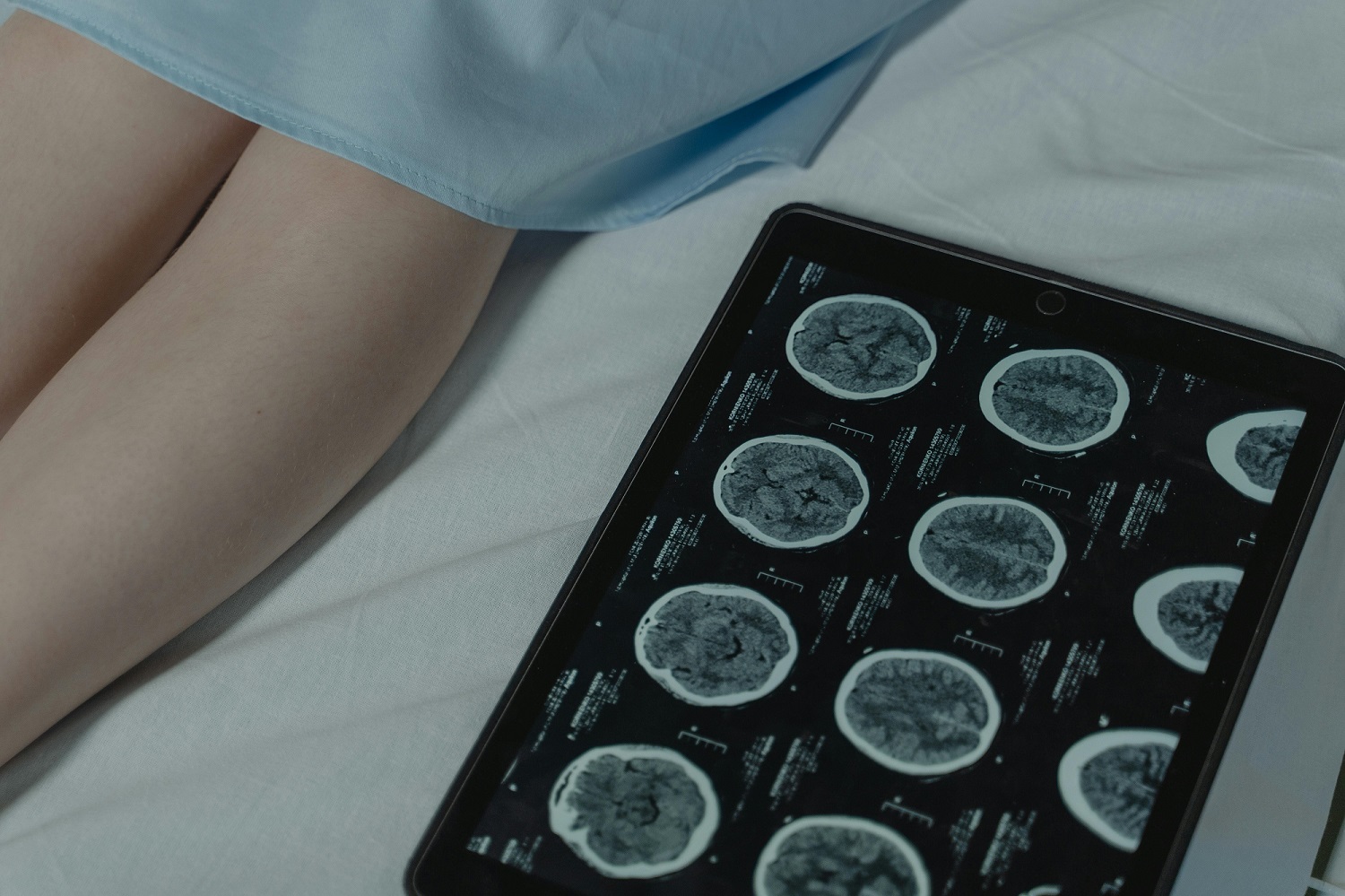A novel source of genetic variation influencing childhood brain tumors