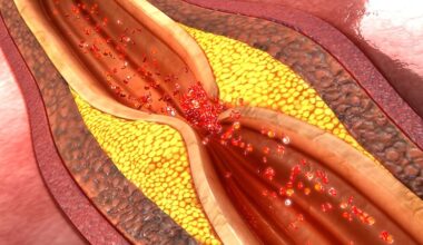 Low-Dose Colchicine May Help Stabilize Coronary Plaques