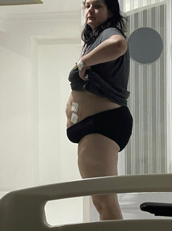 Woman in hospital, showing surgical site.