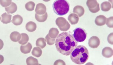 Genetics or Microenvironment: What Drives CLL Progression?