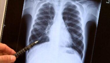 Price of life-changing Cystic Fibrosis drug set to be slashed