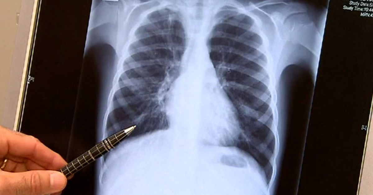 Price of life-changing Cystic Fibrosis drug set to be slashed