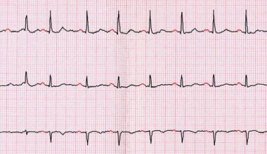 Genetic Tests in AF Patients May Flag Heart Failure Risk