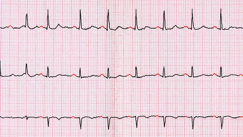 Genetic Tests in AF Patients May Flag Heart Failure Risk