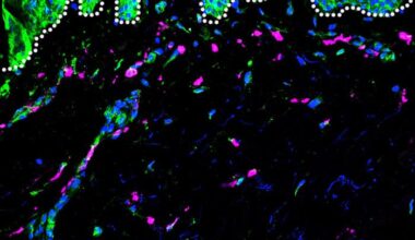Dengue Severity Linked to Genetic Ancestry’s Influence on Immune Response