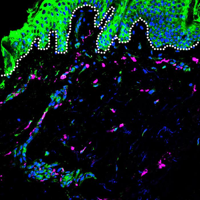 Dengue Severity Linked to Genetic Ancestry’s Influence on Immune Response