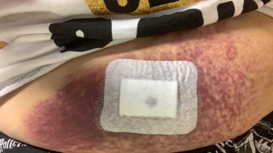 Bruising and a bandage on a person's abdomen.