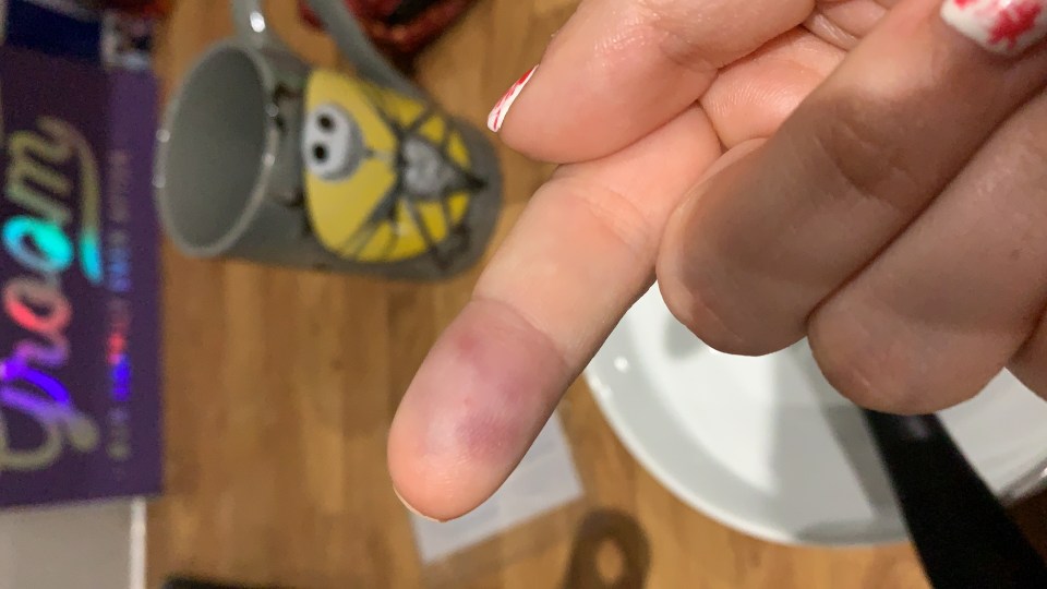 Close-up of a finger with a bruise.