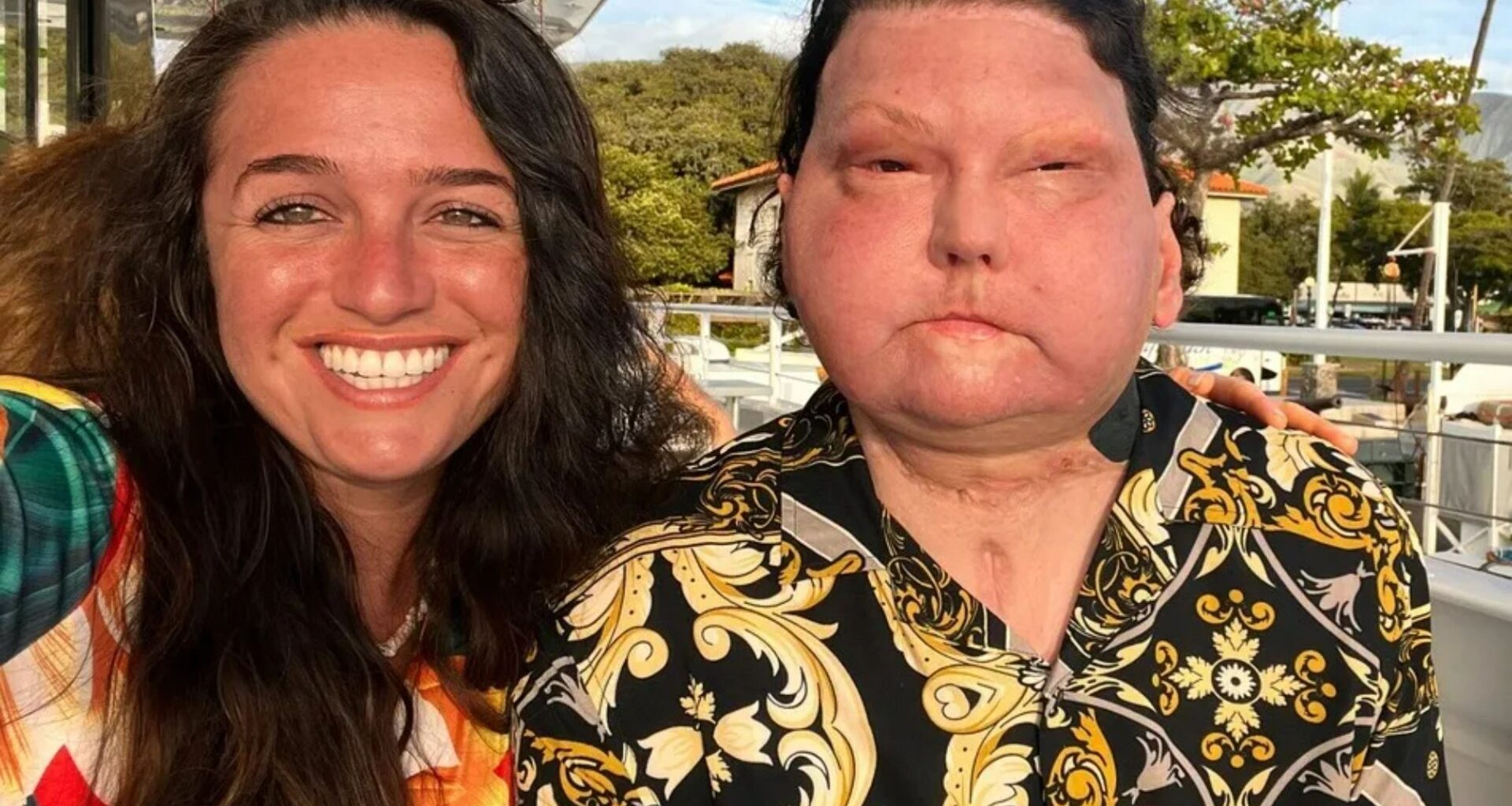 I married the man with the world’s first face transplant - trolls say I’m just a gold digger or have a fetish