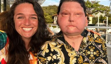I married the man with the world’s first face transplant - trolls say I’m just a gold digger or have a fetish