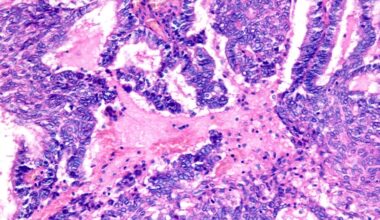 Familial and Genetic Risk in Ovarian Cancer