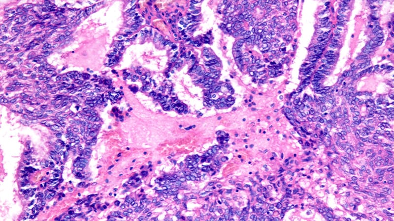 Familial and Genetic Risk in Ovarian Cancer