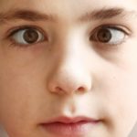 strabismus