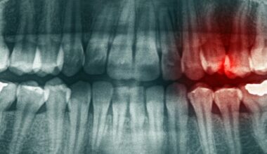 Exercise and omega-3s reduce tooth infection severity