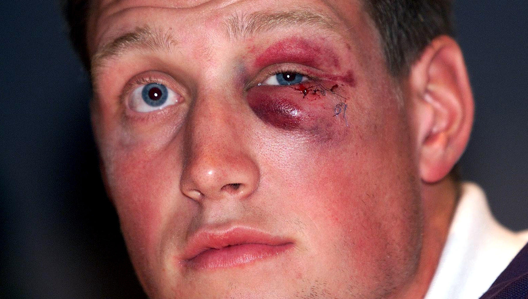 Ronan O'Gara with a severely bruised and cut eye.