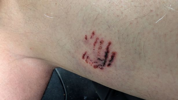 Thankfully, the wound has now begun to heal.
