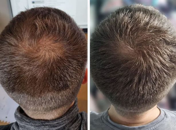 hair growth capsules result