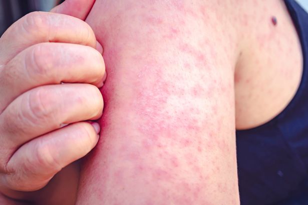  Measles is a disease that can spread easily.