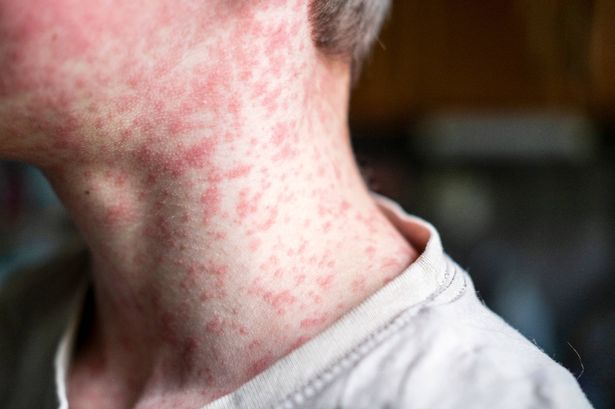 Measles is spiking in Liverpool and Merseyside 