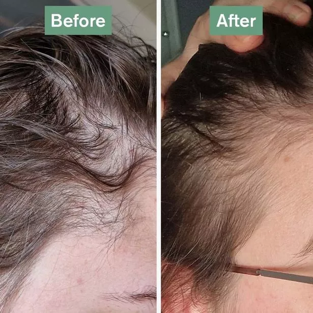 before and after taking hair supplement