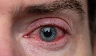The eye drops work by suppressing the immune system and dampening the allergic reaction seasonal allergy sufferers experience - but this specific batch could potentially cause inflammation and serious infection resulting in vision loss