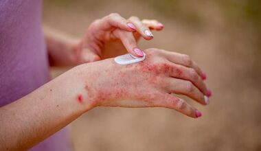 Eczema can often manifest in itchy, stubborn patches on the skin and some creams can help