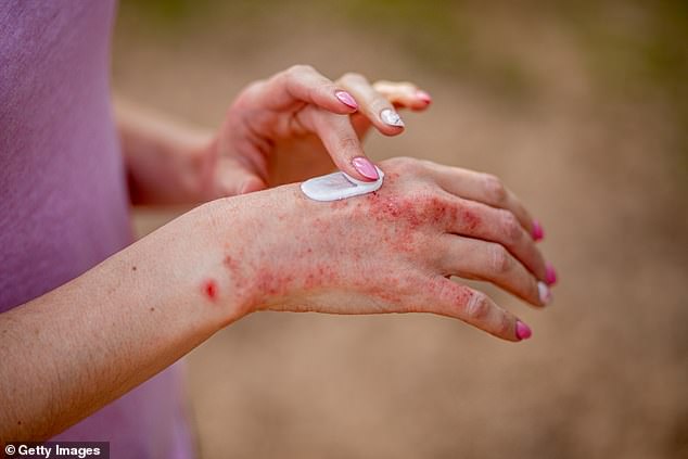 Eczema can often manifest in itchy, stubborn patches on the skin and some creams can help