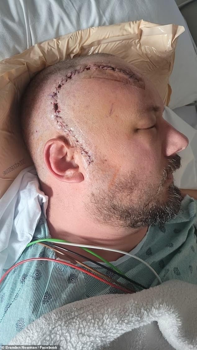To treat the cancer, doctors opened his skull and removed 90 percent of the tumor from his brain. The above photo is from after the surgery