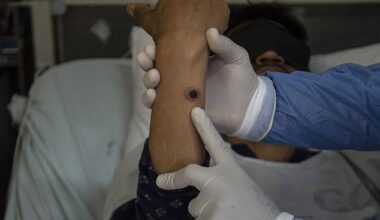 Clade 1 strain of mpox has been found in a patient in Queensland