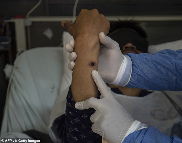 Clade 1 strain of mpox has been found in a patient in Queensland