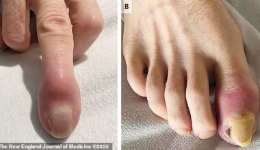 The above shows the man's finger (left) and his toe (right)