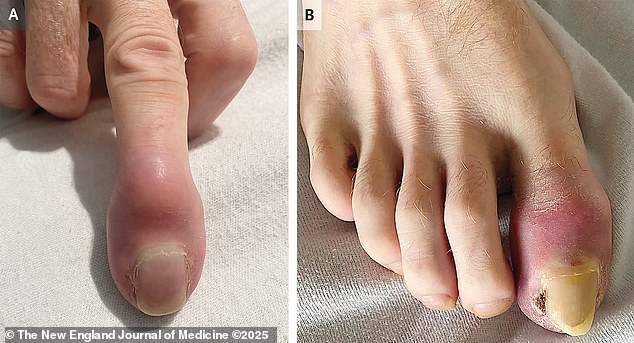 The above shows the man's finger (left) and his toe (right)