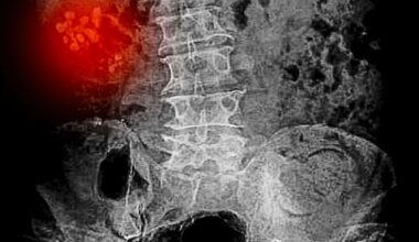 I had undergone a routine procedure to solve a routine problem (kidney stone, agony – avoid!), and since it had plainly been a total success I was bursting with gratitude to the doctors, nurses, staff, anyone involved in restoring me to health, writes Boris Johnson