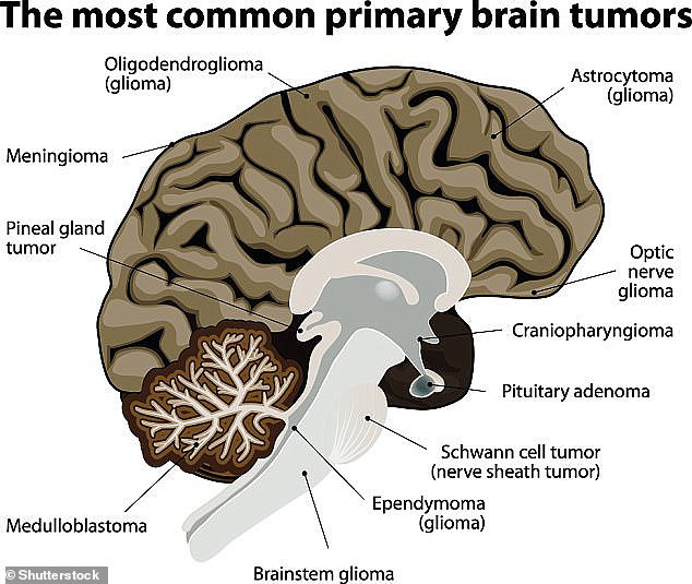 Meningiomas are the most common type of brain tumour, accounting for around a third of all cases