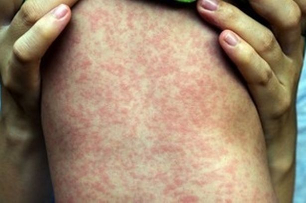 An image of a child with measles