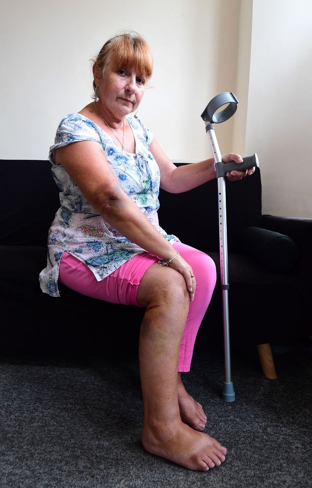 Carol says she spent over 18 hours in A&E after the accident