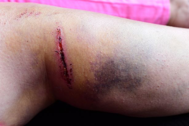 Carol says she has injuries to her arm, legs, ribs and knees