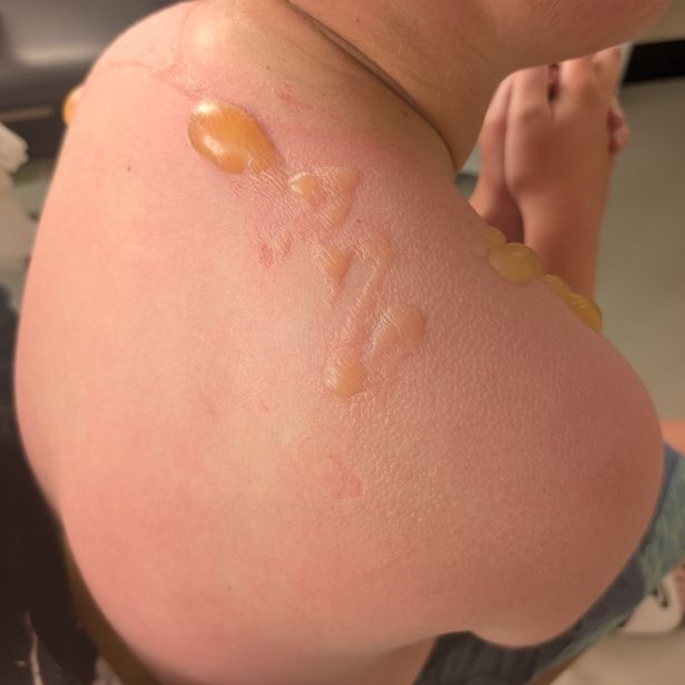 Oliver's blisters