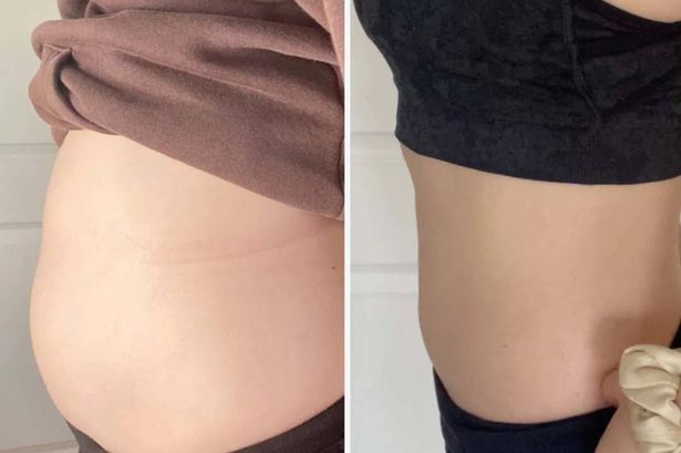 Before and after photos of a stomach after losing weight.