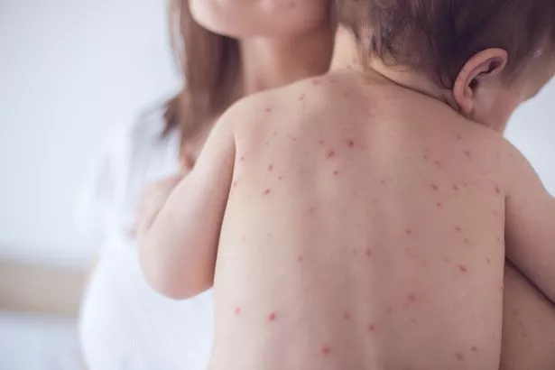 The rash's spots can be raised and merge to form blotchy patches