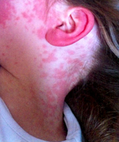 Child's neck and ear with sepsis rash.