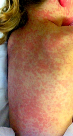 Sepsis rash on a child's back.