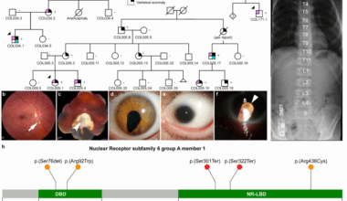 Variants in NR6A1 cause a novel oculo vertebral renal syndrome